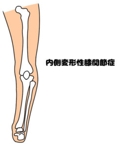 内側変形性膝関節症