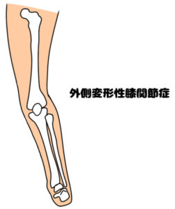 外側変形性膝関節症