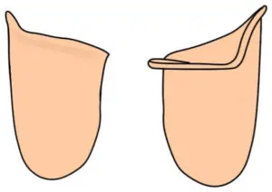 比較 大腿義足ソケット ページ 3 そうだいのpo学生応援ブログ