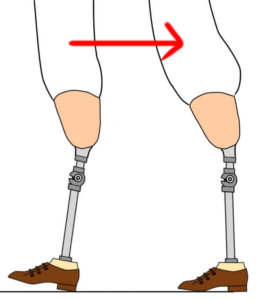 大腿義足における過度な腰椎の前彎