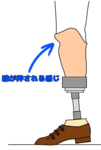 下腿義足において（膝伸展位で）踵が浮き上がっている場合での膝の過安定（後方への不安定）
