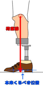 下腿義足において足部が床面に平らに接地している場合での膝折れ感（前方への不安定）