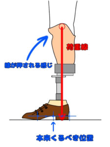 下腿義足において足部が床面に平らに接地している場合での膝の過安定（後方への不安定）