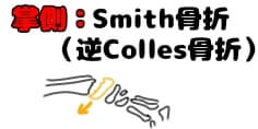 Smith 骨折,逆 Colles 骨折