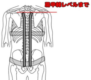 体幹装具_後方支柱（胸腰仙椎装具）